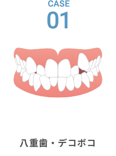 歯がデコボコ・八重歯