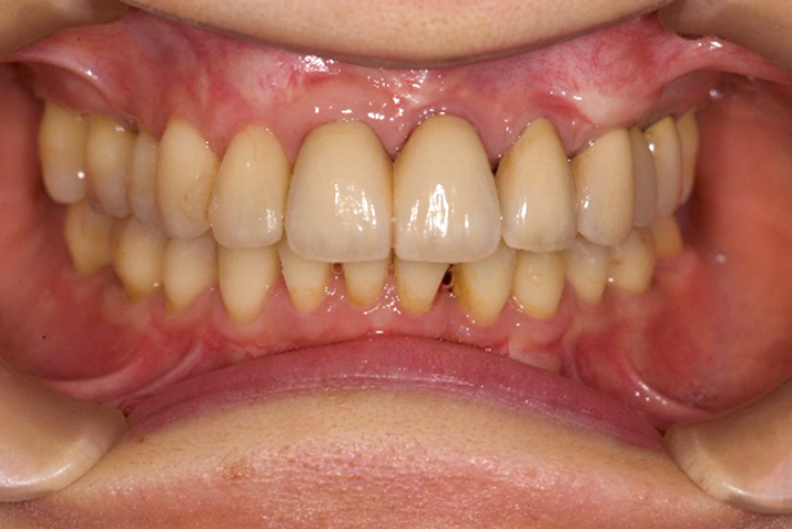 歯周病によるすきっ歯の治療後