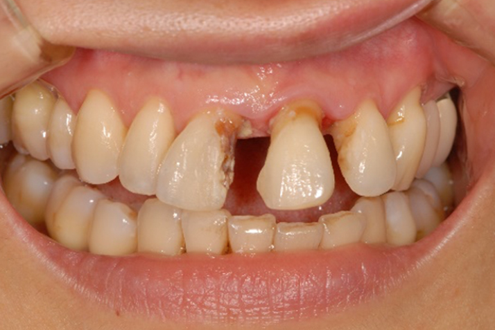 歯周病によるすきっ歯の治療前