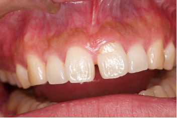 すきっ歯の治療前