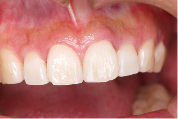 すきっ歯の治療後