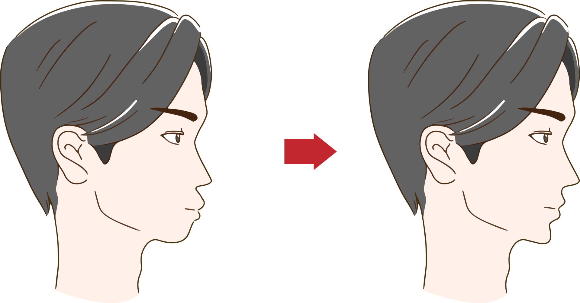 口ゴボの改善イメージ（男性）