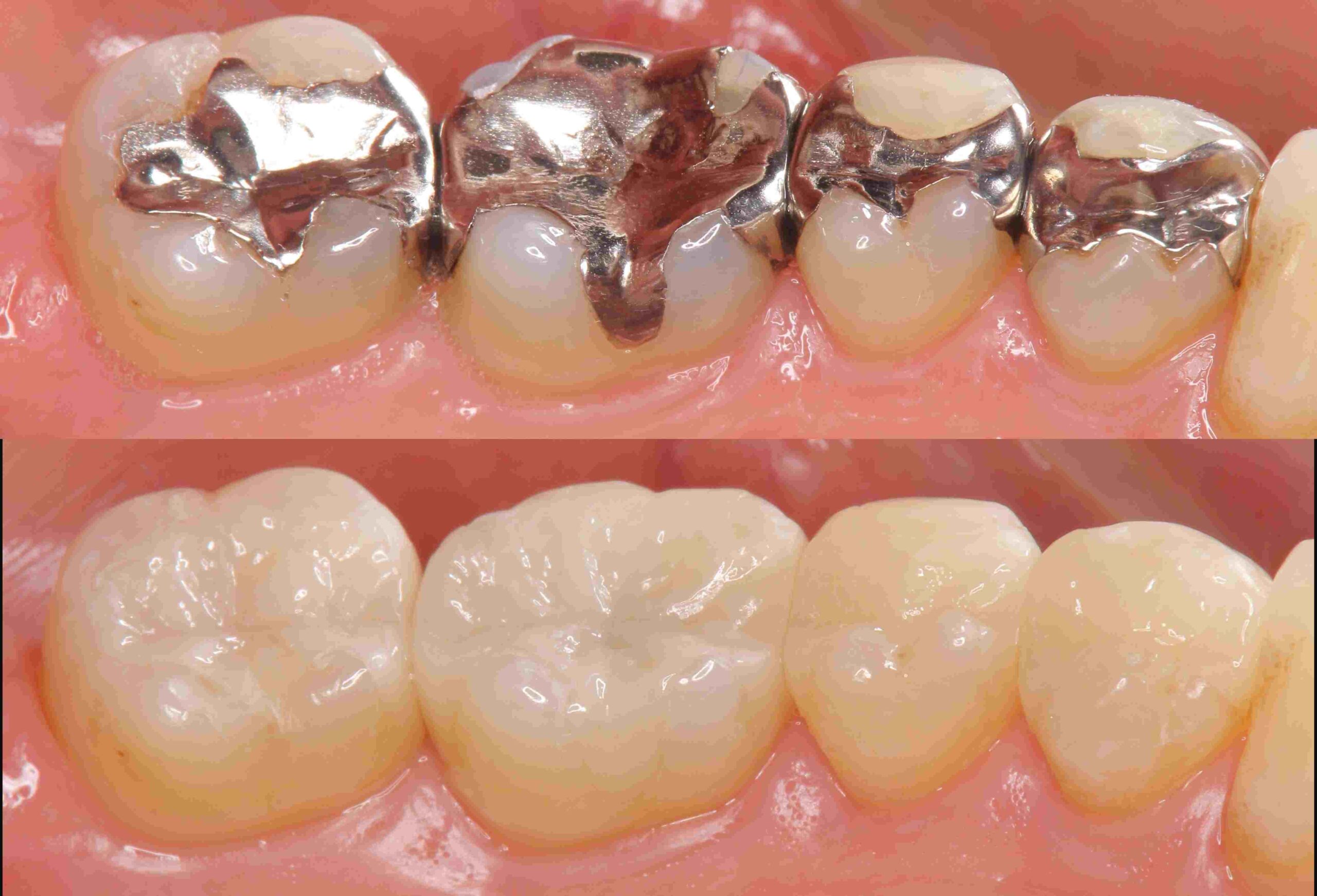 銀歯とセラミックの比較