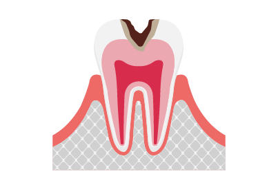 象牙質まで到達した虫歯