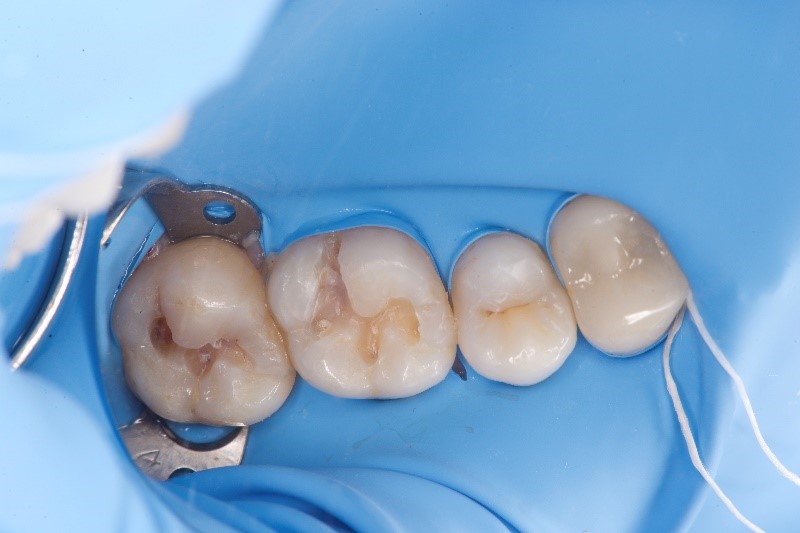 銀歯のダイレクトボンディング治療（術前）