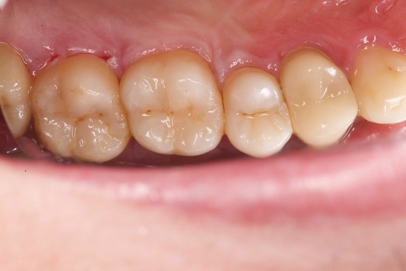 銀歯のダイレクトボンディング治療（術後）