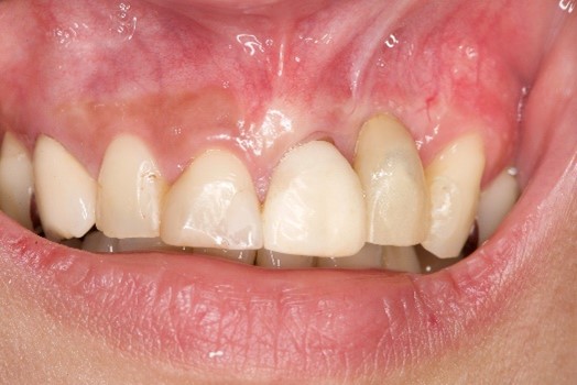 歯が長く見える口腔状況