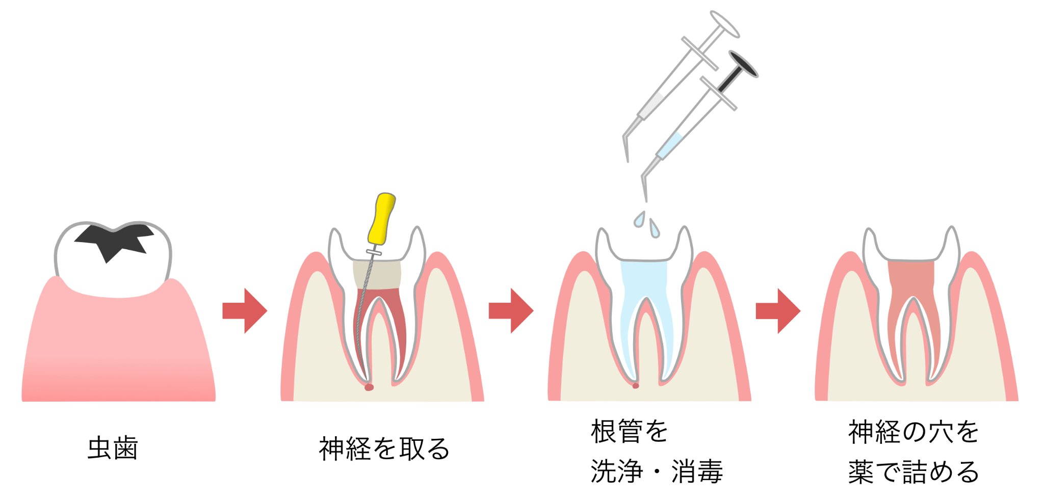 歯内療法の手順